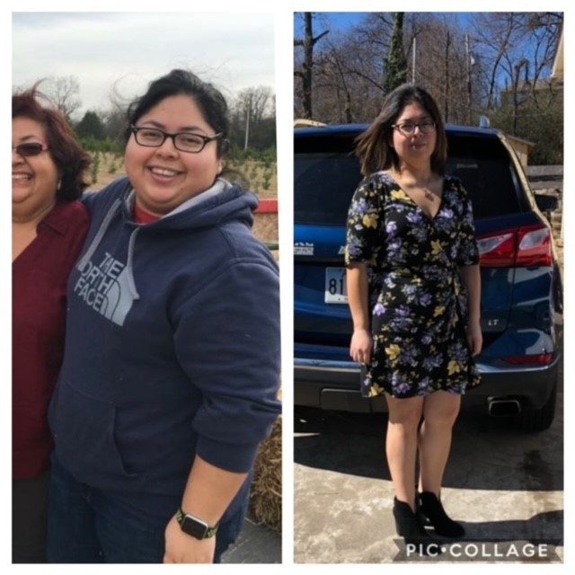 before & after bariatric surgery