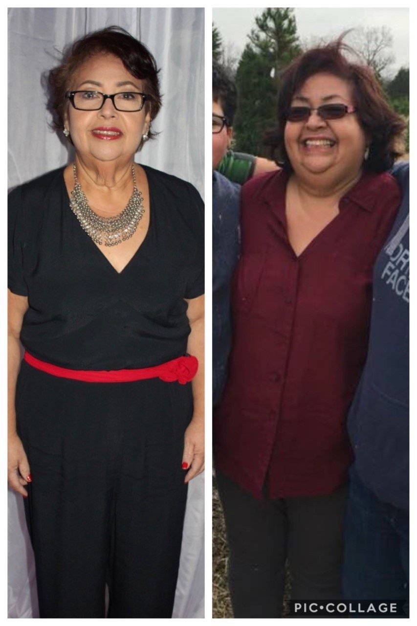 before & after bariatric surgery