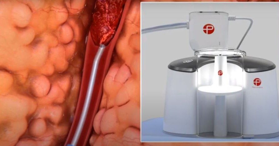 Courtesy: The Indigo® System Lightning™ 12, powered by the Penumbra ENGINE™. This animation shows how the system finds and removes a clot.