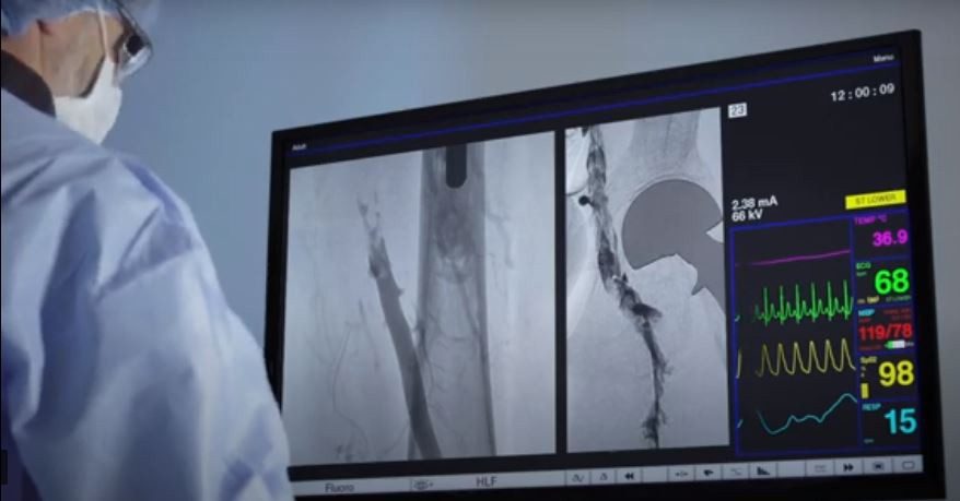 Courtesy: The Indigo® System Lightning™ 12 powered by the Penumbra ENGINE™. A doctor looks at images of a clot.
