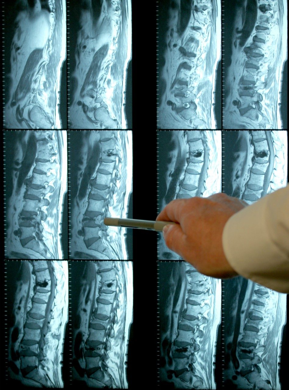 MRI lumbar spine X-ray