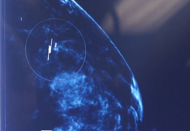 The SAVI SCOUT® marks a tumor, and is detectable to the surgeon through an MRI. The technology guides them to make a precise lumpectomy.