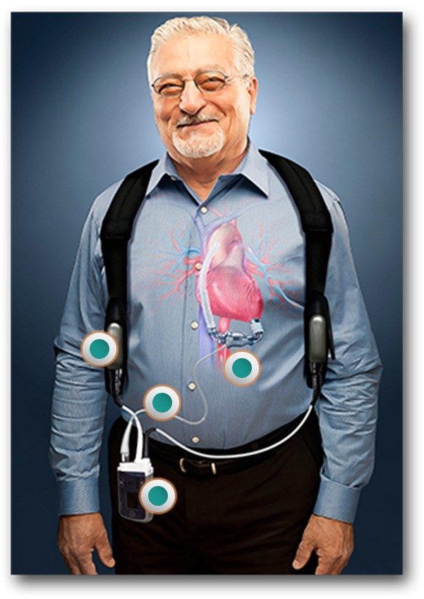 A left ventricular assist device (LVAD) replaces some of the work of a patient's left ventricle, constantly circulating blood throughout the body. Image courtesy: Thoratec