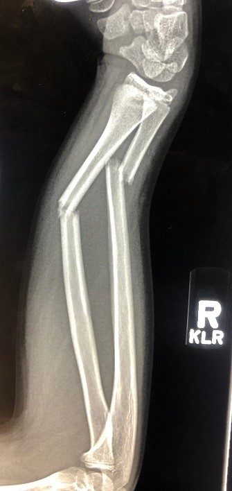 michael_muse_broken_arm_xray_before_ada