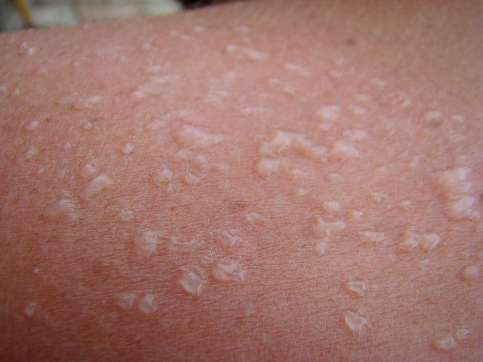 Brown Spots After Sunburn