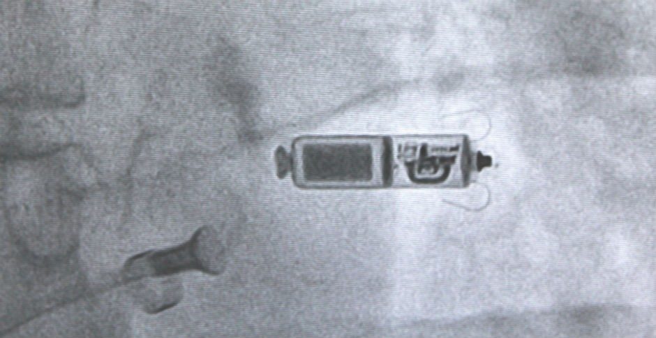 An internal view of the procedure shows the device being placed in the heart.
