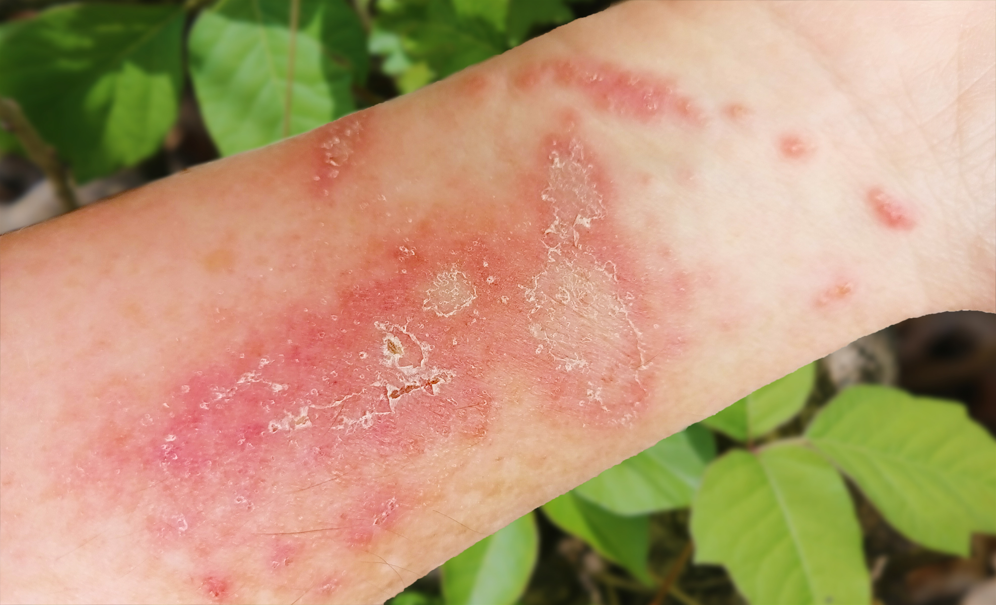 show me poison ivy rash