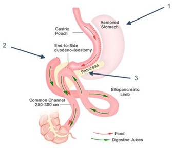 Single Anastomosis Duodenal Switch 