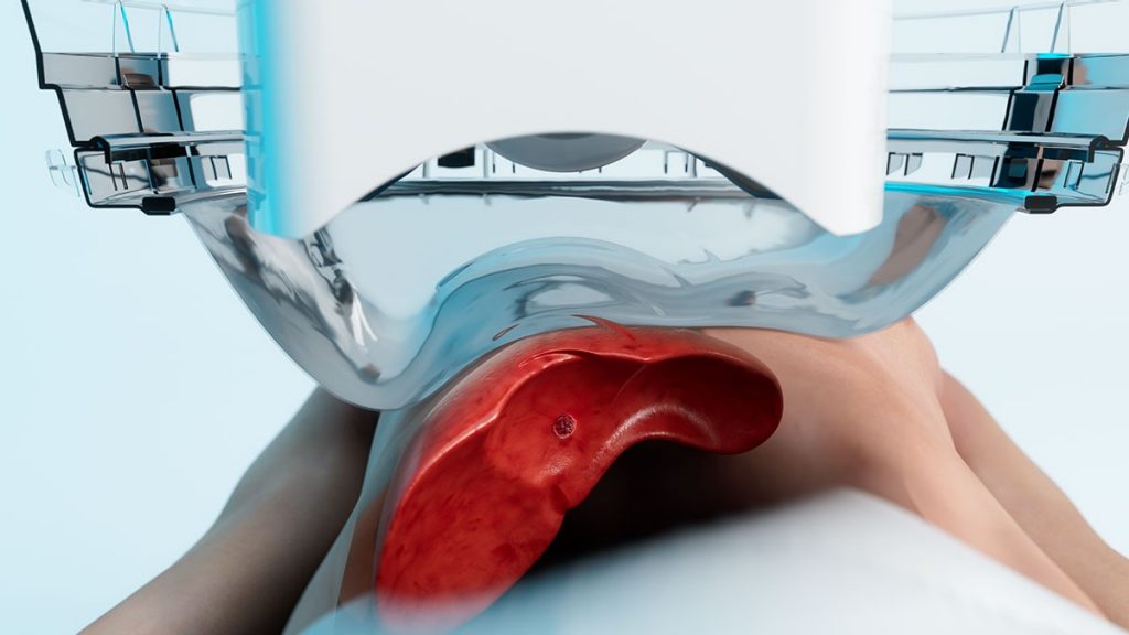 WEB-Service-Page-Histotripsy-Patient-Liver-with-Patient-Membrane